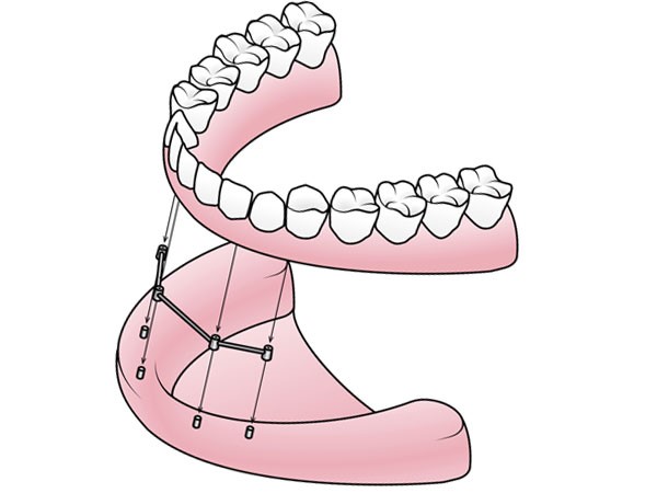 Immediate Dentures Procedure Selden NY 11784